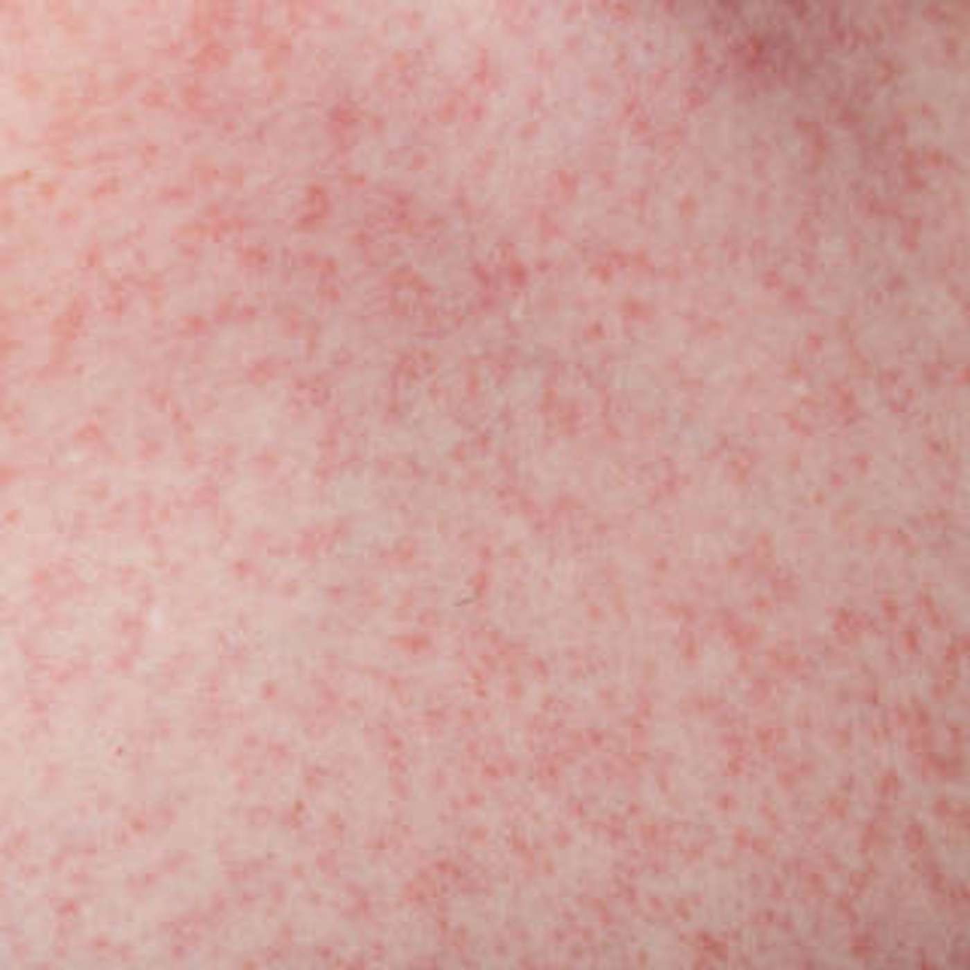 cover of episode Rocky Mountain Spotted Fever